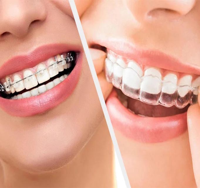 best clear aligner treatment in trivandrum